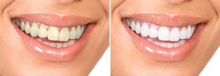 teeth whitening in north canton ohio